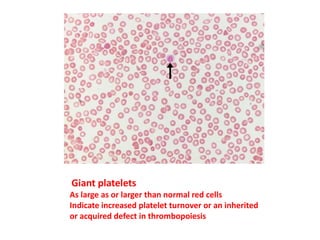 Giant platelets
As large as or larger than normal red cells
Indicate increased platelet turnover or an inherited
or acquired defect in thrombopoiesis
 