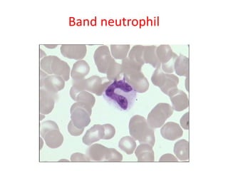 Band neutrophil
 