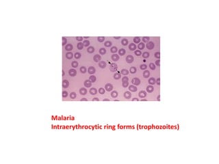 Malaria
Intraerythrocytic ring forms (trophozoites)
 