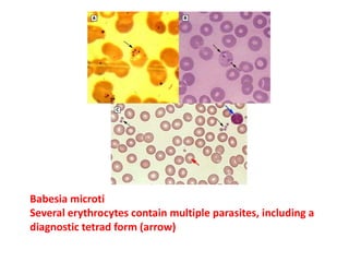 Babesia microti
Several erythrocytes contain multiple parasites, including a
diagnostic tetrad form (arrow)
 