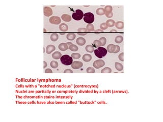 Follicular lymphoma
Cells with a "notched nucleus" (centrocytes)
Nuclei are partially or completely divided by a cleft (arrows).
The chromatin stains intensely
These cells have also been called "buttock" cells.
 