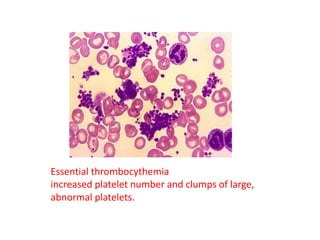 Essential thrombocythemia
increased platelet number and clumps of large,
abnormal platelets.
 