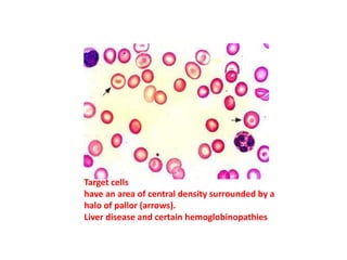 Target cells
have an area of central density surrounded by a
halo of pallor (arrows).
Liver disease and certain hemoglobinopathies
 