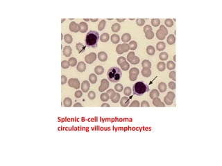Splenic B-cell lymphoma
circulating villous lymphocytes
 