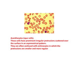 Acanthocytes (spur cells).
These cells have prominent irregular protrusions scattered over
the surface in an asymmetrical pattern.
They are often confused with echinocytes in which the
protrusions are smaller and more regular
 