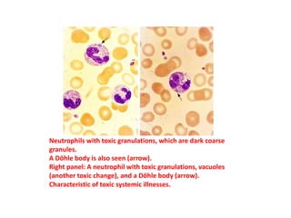 Neutrophils with toxic granulations, which are dark coarse
granules.
A Döhle body is also seen (arrow).
Right panel: A neutrophil with toxic granulations, vacuoles
(another toxic change), and a Döhle body (arrow).
Characteristic of toxic systemic illnesses.
 