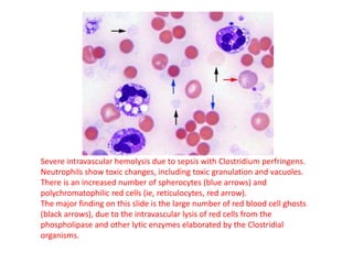 Severe intravascular hemolysis due to sepsis with Clostridium perfringens.
Neutrophils show toxic changes, including toxic granulation and vacuoles.
There is an increased number of spherocytes (blue arrows) and
polychromatophilic red cells (ie, reticulocytes, red arrow).
The major finding on this slide is the large number of red blood cell ghosts
(black arrows), due to the intravascular lysis of red cells from the
phospholipase and other lytic enzymes elaborated by the Clostridial
organisms.
 