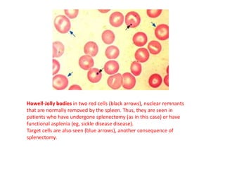 Howell-Jolly bodies in two red cells (black arrows), nuclear remnants
that are normally removed by the spleen. Thus, they are seen in
patients who have undergone splenectomy (as in this case) or have
functional asplenia (eg, sickle disease disease).
Target cells are also seen (blue arrows), another consequence of
splenectomy.
 