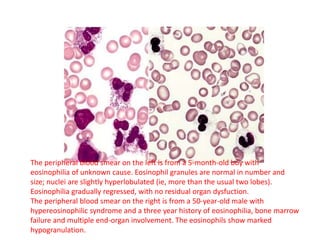 The peripheral blood smear on the left is from a 5-month-old boy with
eosinophilia of unknown cause. Eosinophil granules are normal in number and
size; nuclei are slightly hyperlobulated (ie, more than the usual two lobes).
Eosinophilia gradually regressed, with no residual organ dysfuction.
The peripheral blood smear on the right is from a 50-year-old male with
hypereosinophilic syndrome and a three year history of eosinophilia, bone marrow
failure and multiple end-organ involvement. The eosinophils show marked
hypogranulation.
 