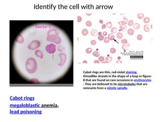 Poison Strands BLOOD film for study of pediatrics , md part 1 | PPTX