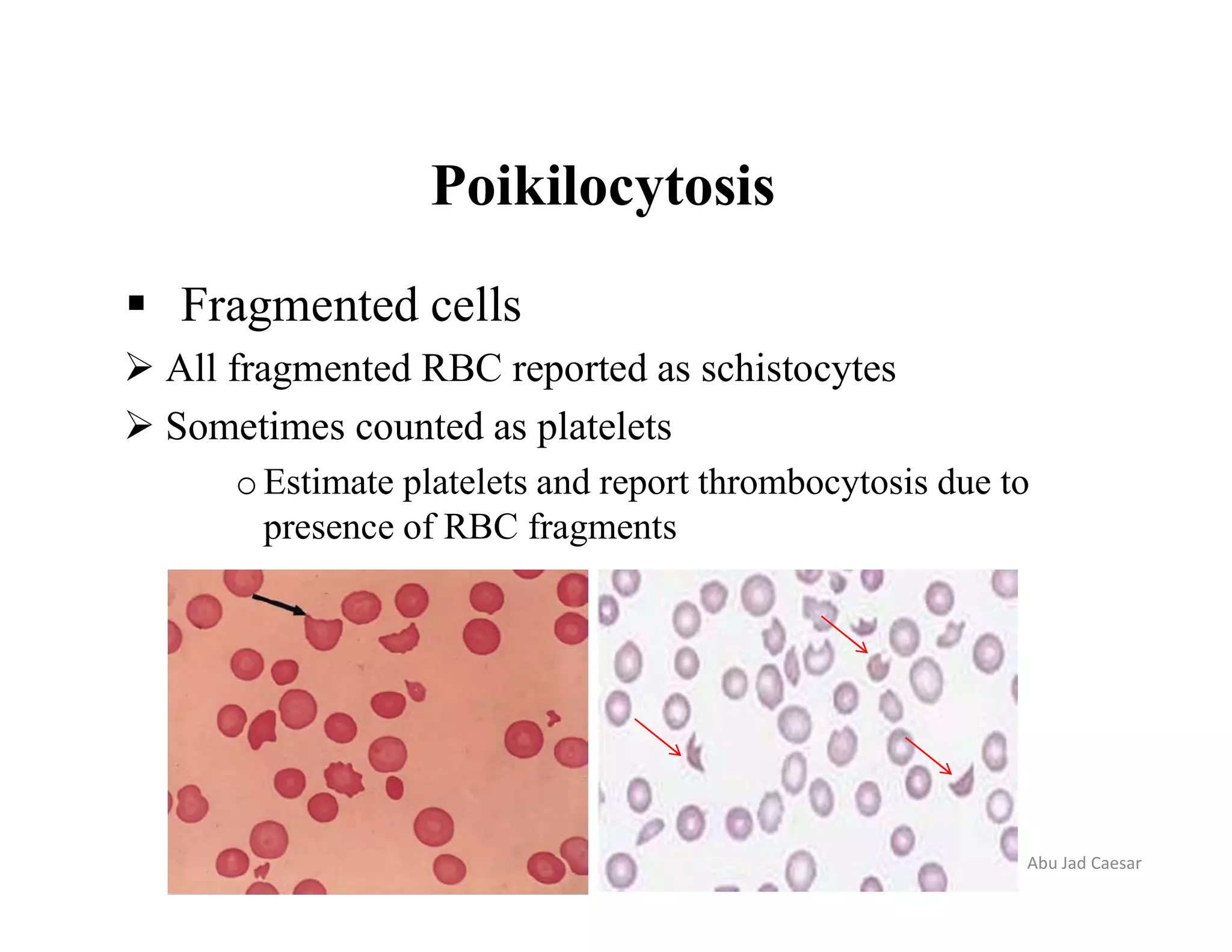 Blood film preparation and reporting | PDF