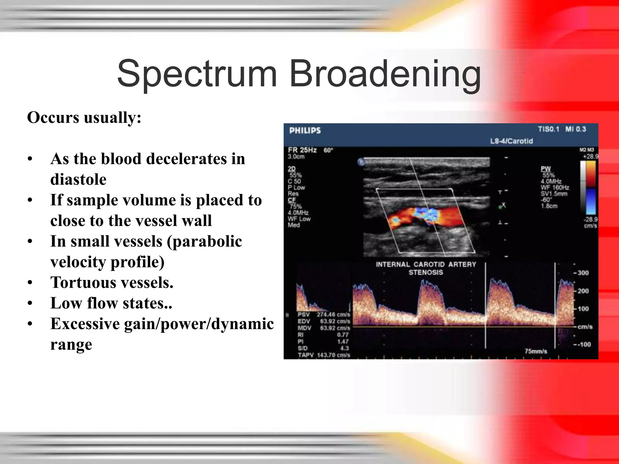 Spectrum Broadening
Occurs usually:

• As the blood decelerates in
diastole
• If sample volume is placed to
close to the vessel wall
• In small vessels (parabolic
velocity profile)
• Tortuous vessels.
• Low flow states..
• Excessive gain/power/dynamic
range

 
