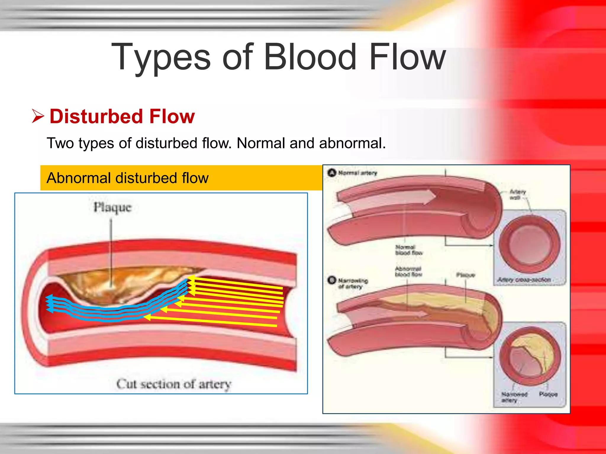 Types of Blood Flow
 Disturbed Flow
Two types of disturbed flow. Normal and abnormal.
Abnormal disturbed flow

 