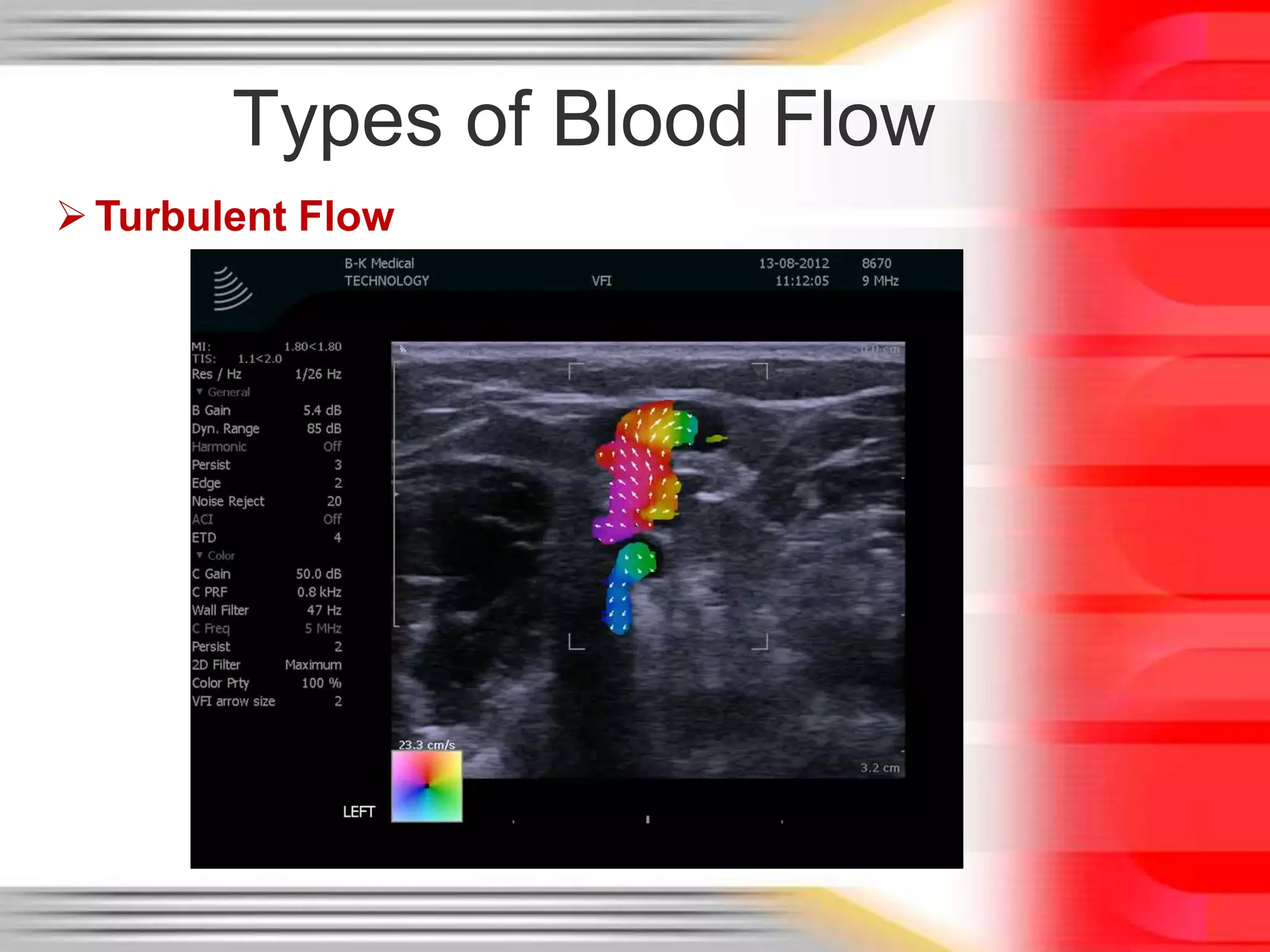 Types of Blood Flow
 Turbulent Flow

 