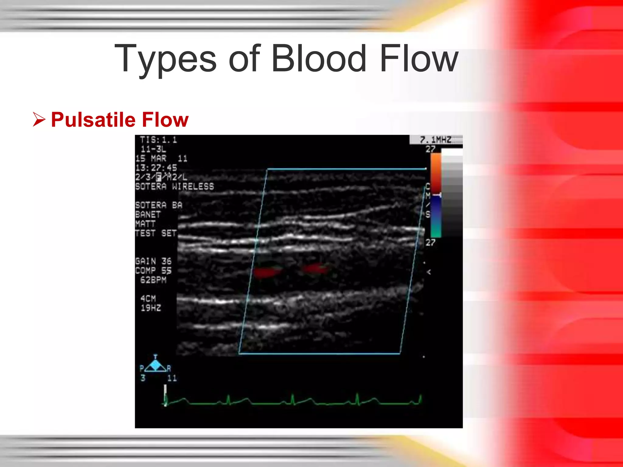 Types of Blood Flow
 Pulsatile Flow

 