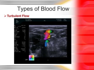 Types of Blood Flow
 Turbulent Flow

 