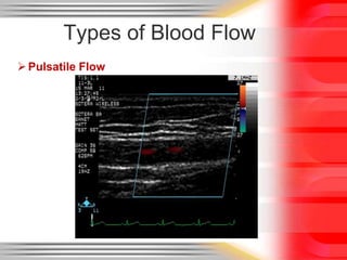 Types of Blood Flow
 Pulsatile Flow

 