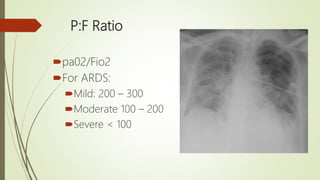 P F Ratio Example Blood Gas Interpretation | PPTX