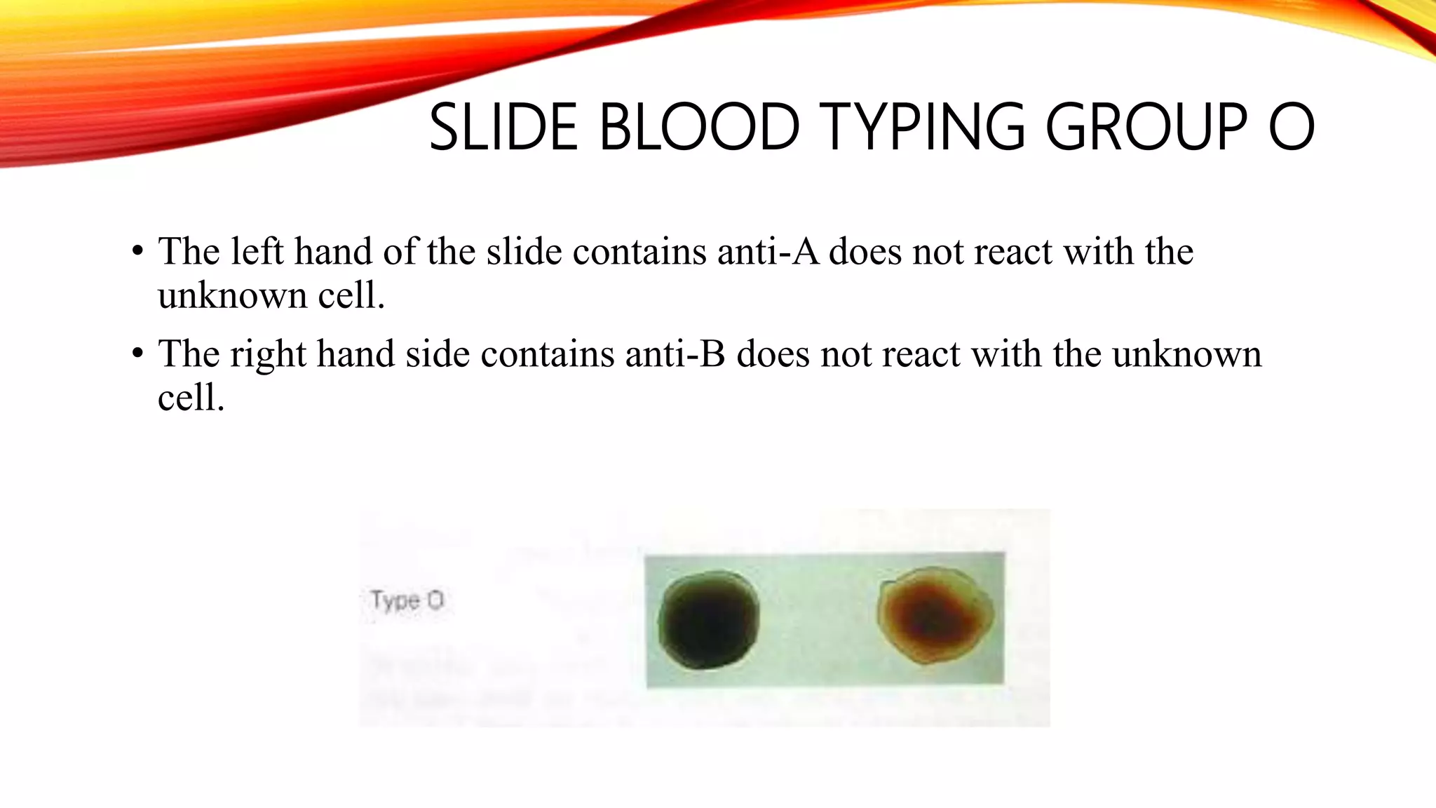 SLIDE BLOOD TYPING GROUP O
• The left hand of the slide contains anti-A does not react with the
unknown cell.
• The right hand side contains anti-B does not react with the unknown
cell.
 