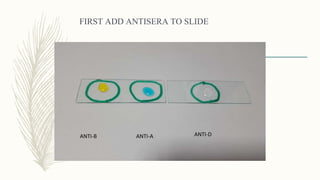 FIRST ADD ANTISERA TO SLIDE
ANTI-B ANTI-A ANTI-D
 