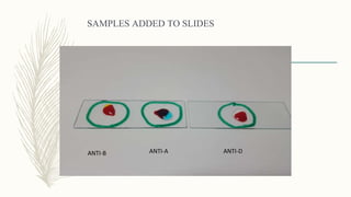 SAMPLES ADDED TO SLIDES
ANTI-B ANTI-A ANTI-D
 