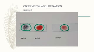 OBSERVE FOR AGGLUTINATION
sample 1
ANTI-A ANTI-B ANTI-D
 