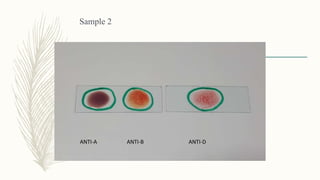 Sample 2
ANTI-A ANTI-B ANTI-D
 
