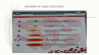 GRADING OF AGGLUTINATION
 