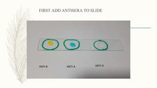 SAMPLES ADDED TO SLIDES
ANTI-B ANTI-A ANTI-D
 