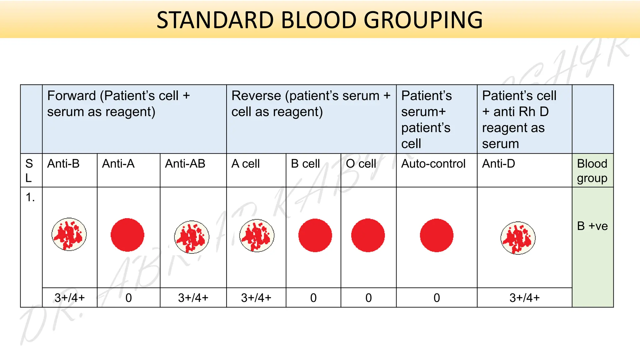 Forward (Patient’s cell +
serum as reagent)
Reverse (patient’s serum +
cell as reagent)
Patient’s
serum+
patient’s
cell
Patient’s cell
+ anti Rh D
reagent as
serum
S
L
Anti-B Anti-A Anti-AB A cell B cell O cell Auto-control Anti-D Blood
group
1.
B +ve
3+/4+ 0 3+/4+ 3+/4+ 0 0 0 3+/4+
STANDARD BLOOD GROUPING
 