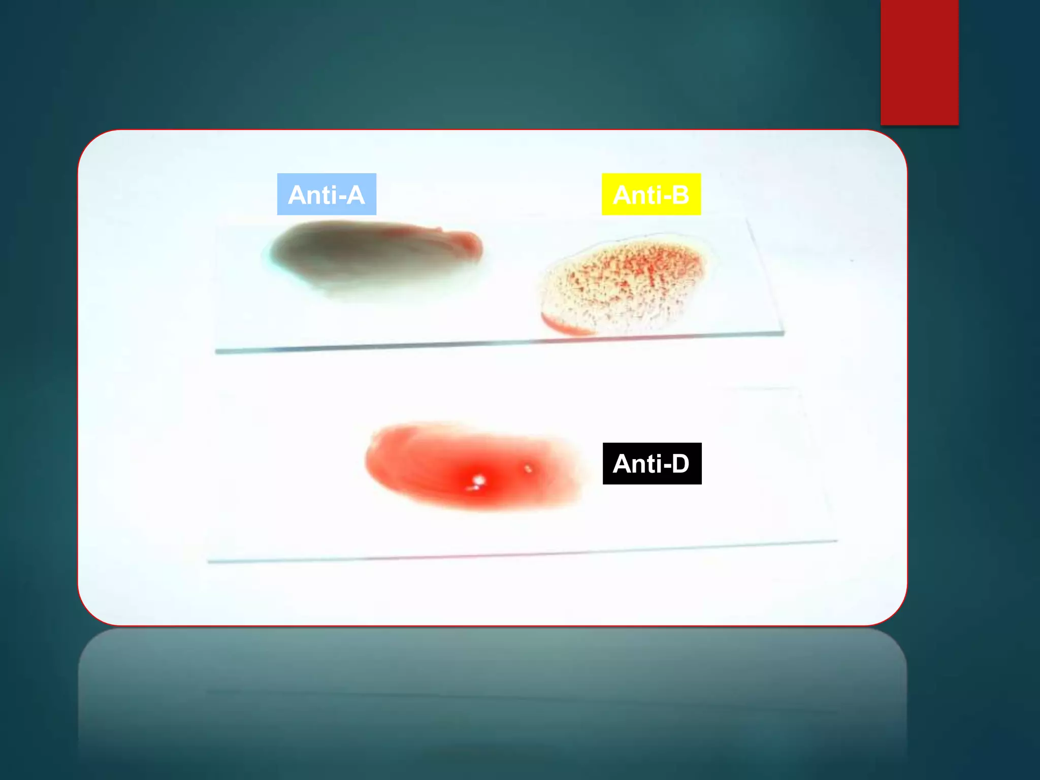 Blood Group Systems_ABO & Rh.ppt