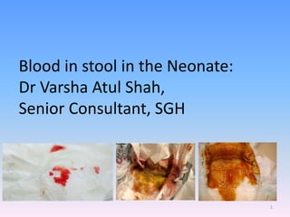 Blood in stool in the Neonate:
Dr Varsha Atul Shah,
Senior Consultant, SGH
1
 