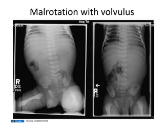 Malrotation with volvulus
24
Source undetermined
 
