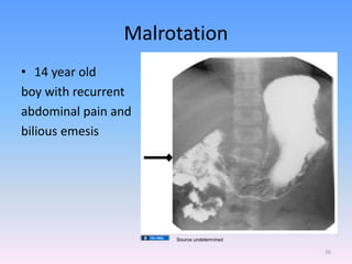Malrotation
• 14 year old
boy with recurrent
abdominal pain and
bilious emesis
26
Source undetermined
 