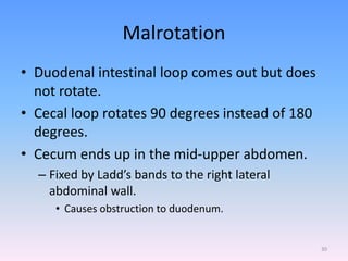 Malrotation
• Duodenal intestinal loop comes out but does
not rotate.
• Cecal loop rotates 90 degrees instead of 180
degrees.
• Cecum ends up in the mid-upper abdomen.
– Fixed by Ladd’s bands to the right lateral
abdominal wall.
• Causes obstruction to duodenum.
30
 