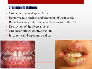 Oral manifestations
• Gingivitis, gingival hyperplasia
• Hemorrhage, petechiae and ulceration of the mucosa
• Rapid loosening of the tooth due to necrosis of the PDL
• Destruction of the alveolar bone
• Oral mucositis, exfoliative cheilitis
• Infection with herpes and candida
 
