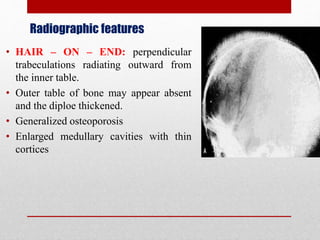 Radiographic features
• HAIR – ON – END: perpendicular
trabeculations radiating outward from
the inner table.
• Outer table of bone may appear absent
and the diploe thickened.
• Generalized osteoporosis
• Enlarged medullary cavities with thin
cortices
 