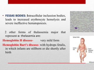 • FESSAS BODIES: Intracellular inclussion bodies,
leads to increased erythrocyte hemolysis and
severe ineffective hematopoiesis.
2 other forms of thalassemia major that
represent α- thelasemia are:
Hemoglobin H disease- very mild form
Hemoglobin Bart’s disease- with hydrops fetalis,
in which infants are stillborn or die shortly after
birth
 
