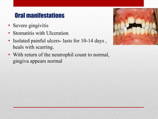 Oral manifestations
• Severe gingivitis
• Stomatitis with Ulceration
• Isolated painful ulcers- lasts for 10-14 days ,
heals with scarring.
• With return of the neutrophil count to normal,
gingiva appears normal
 