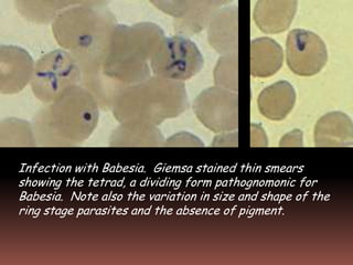 Infection with Babesia. Giemsa stained thin smears
showing the tetrad, a dividing form pathognomonic for
Babesia. Note also the variation in size and shape of the
ring stage parasites and the absence of pigment.
 