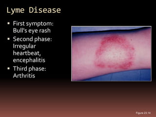 Lyme Disease
 First symptom:
  Bull's eye rash
 Second phase:
  Irregular
  heartbeat,
  encephalitis
 Third phase:
  Arthritis




                    Figure 23.14
 
