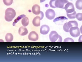 Gametocytes of P. falciparum in thin blood
smears. Note the presence of a “Laveran’s bib”,
which is not always visible.
 