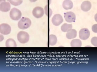 P. falciparum rings have delicate cytoplasm and 1 or 2 small
chromatin dots. Red blood cells (RBCs) that are infected are not
enlarged; multiple infection of RBCs more common in P. falciparum
than in other species. Occasional appliqué forms (rings appearing
on the periphery of the RBC) can be present.
 