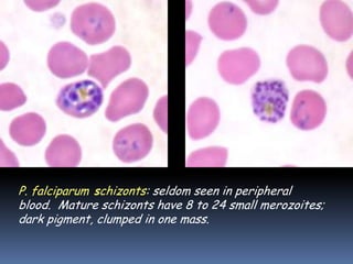 P. falciparum schizonts: seldom seen in peripheral
blood. Mature schizonts have 8 to 24 small merozoites;
dark pigment, clumped in one mass.
 