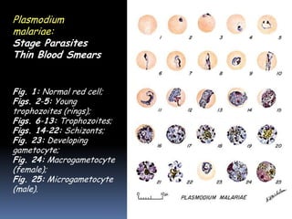 Plasmodium
malariae: Blood
Stage Parasites
Thin Blood Smears


Fig. 1: Normal red cell;
Figs. 2-5: Young
trophozoites (rings);
Figs. 6-13: Trophozoites;
Figs. 14-22: Schizonts;
Fig. 23: Developing
gametocyte;
Fig. 24: Macrogametocyte
(female);
Fig. 25: Microgametocyte
(male).
 