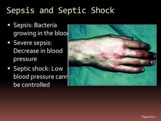 Sepsis and Septic Shock
 Sepsis: Bacteria
  growing in the blood
 Severe sepsis:
  Decrease in blood
  pressure
 Septic shock: Low
  blood pressure cannot
  be controlled



                          Figure 23.3
 