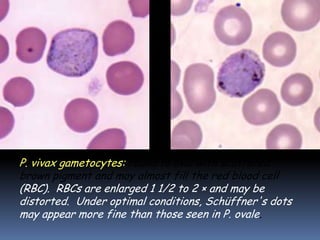 P. vivax gametocytes: round to oval with scattered
brown pigment and may almost fill the red blood cell
(RBC). RBCs are enlarged 1 1/2 to 2 × and may be
distorted. Under optimal conditions, Schüffner's dots
may appear more fine than those seen in P. ovale.
 