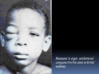 Ramana's sign: unilateral
conjunctivitis and orbital
edema
 
