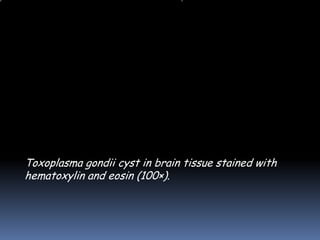 Toxoplasma gondii cyst in brain tissue stained with
hematoxylin and eosin (100×).
 