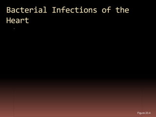 Bacterial Infections of the
Heart




                              Figure 23.4
 